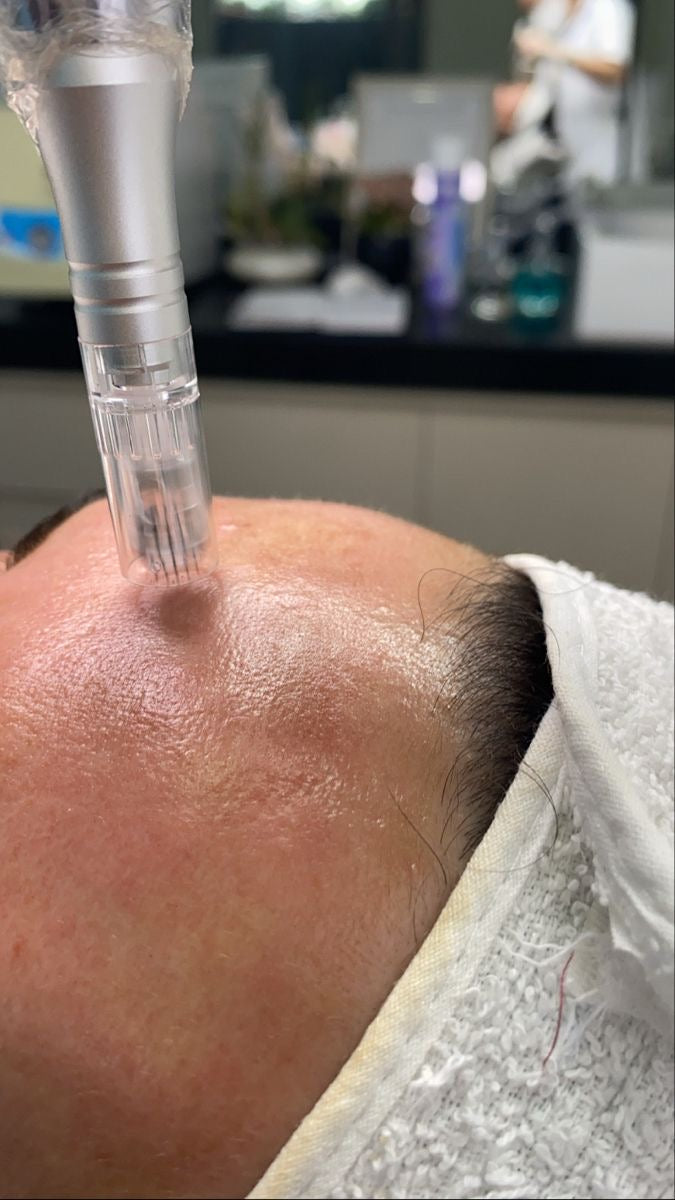 Formation Microneedling